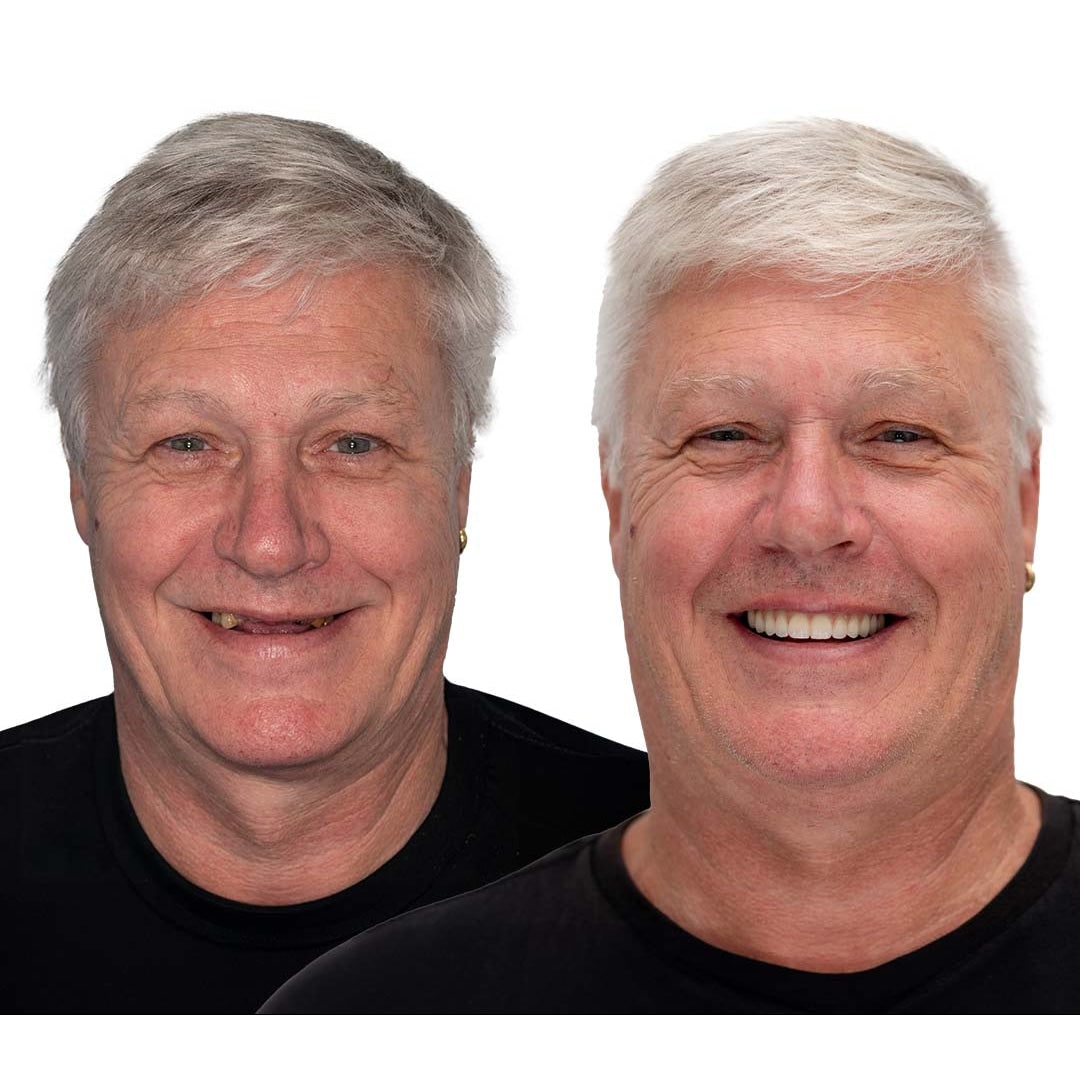 Affordable Removable Dentures with Flexible Cushion Grip Full Arch Set Cleaning - Image 11