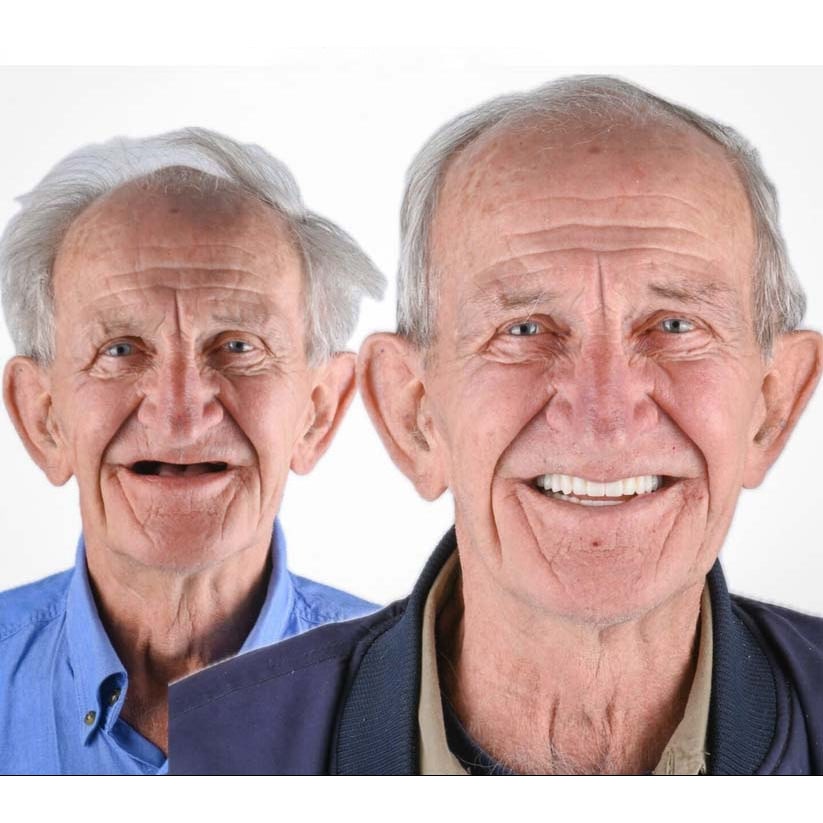Affordable Removable Dentures with Flexible Cushion Grip Full Arch Set Cleaning - Image 12