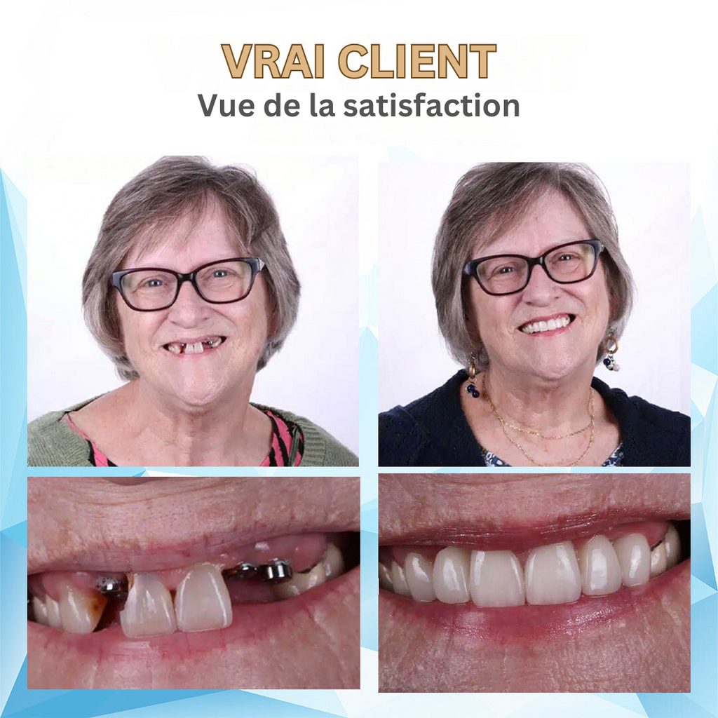Dental Flipper Front Tooth Temporary Snap on Dentures with Silicone Reline Kit and Moldable Strips - Image 14