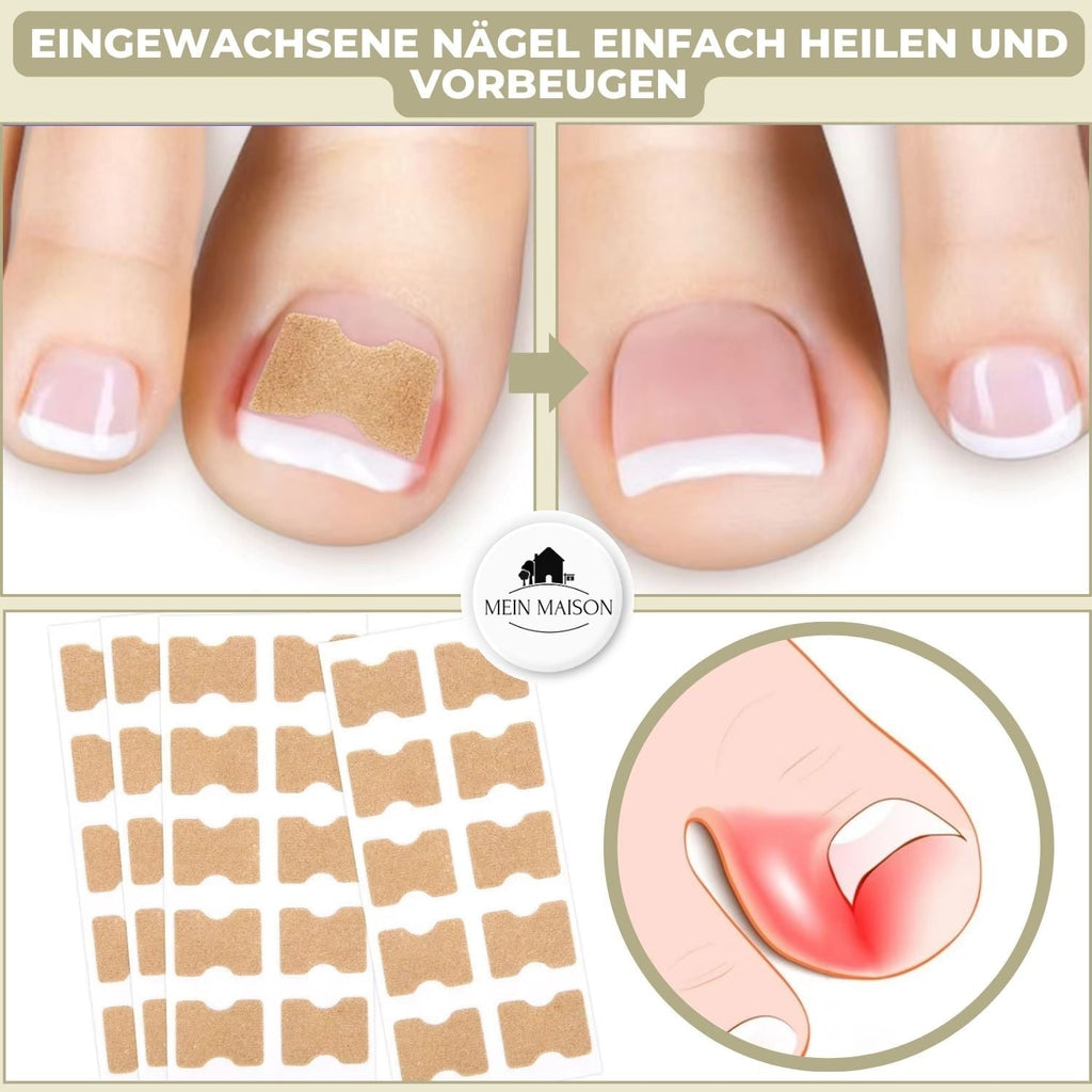 Ingrown Toenail Patches with Adhesive Backing for Nail Straightening 20 Count - Image 2