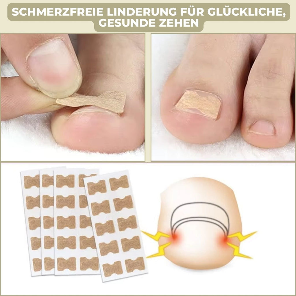 Ingrown Toenail Patches with Adhesive Backing for Nail Straightening 20 Count - Image 3