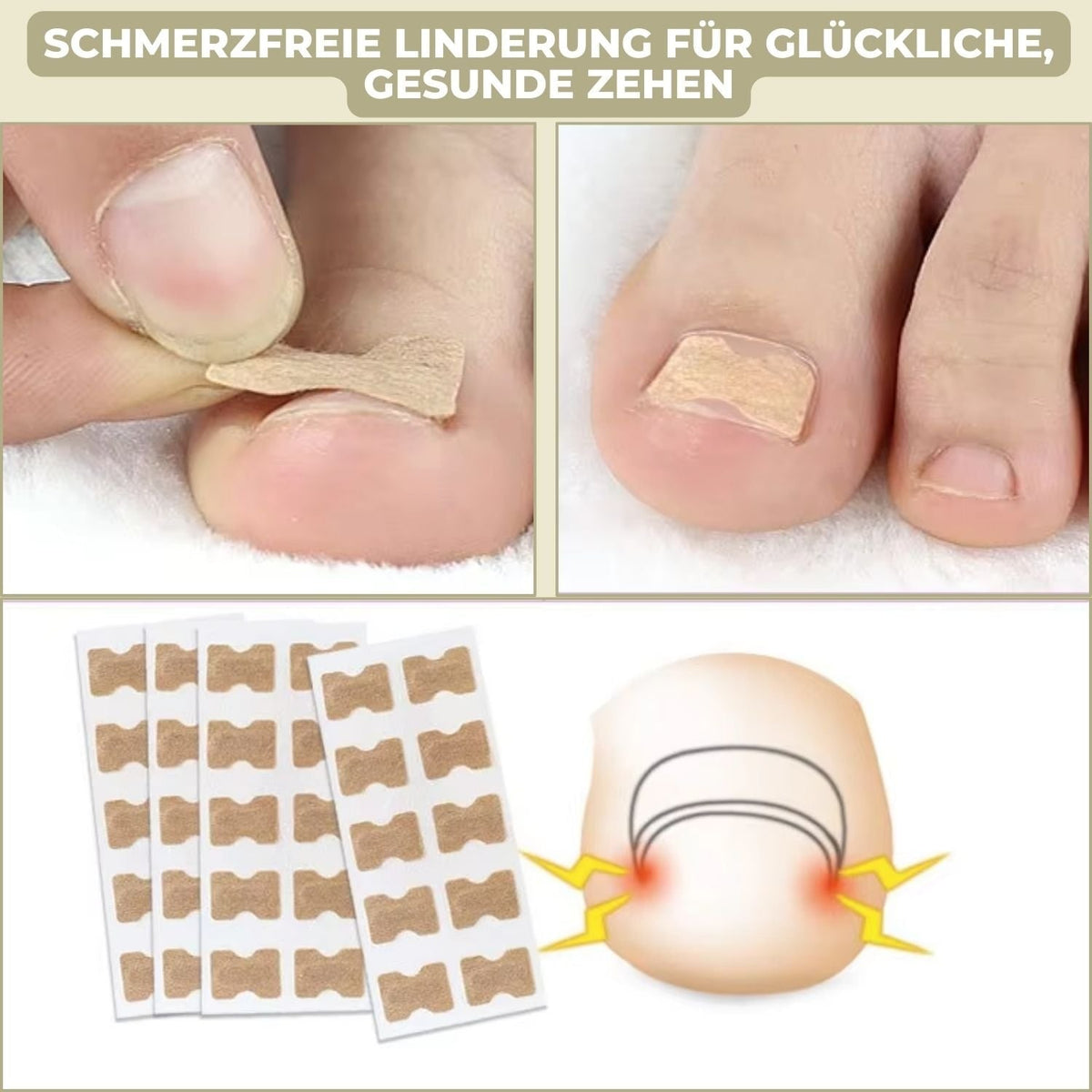 Ingrown Toenail Patches with Adhesive Backing for Nail Straightening 20 Count - Image 3