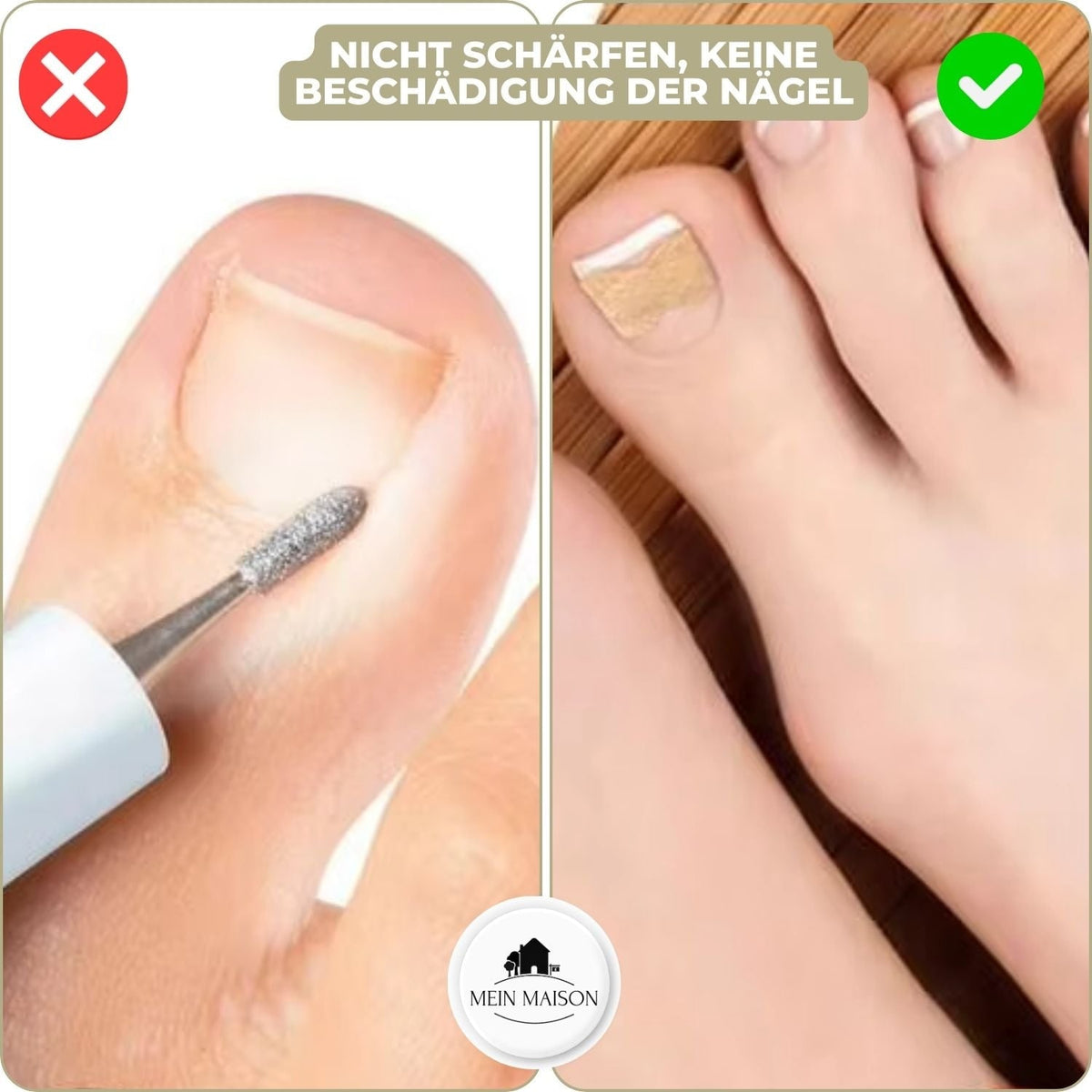 Ingrown Toenail Patches with Adhesive Backing for Nail Straightening 20 Count - Image 5