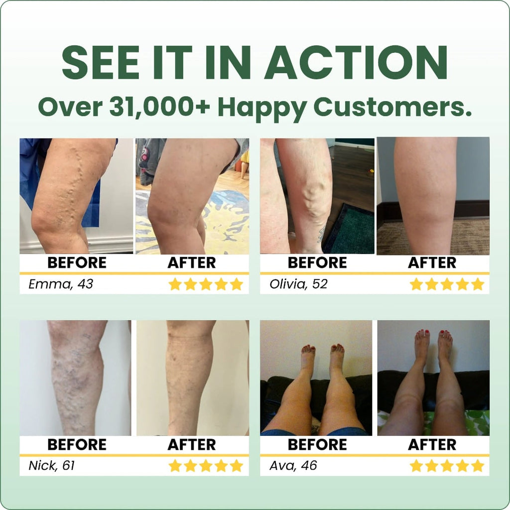 Leg Swelling Cream with Horse Chestnut and Arnica Varicose Vein Balm - Image 13