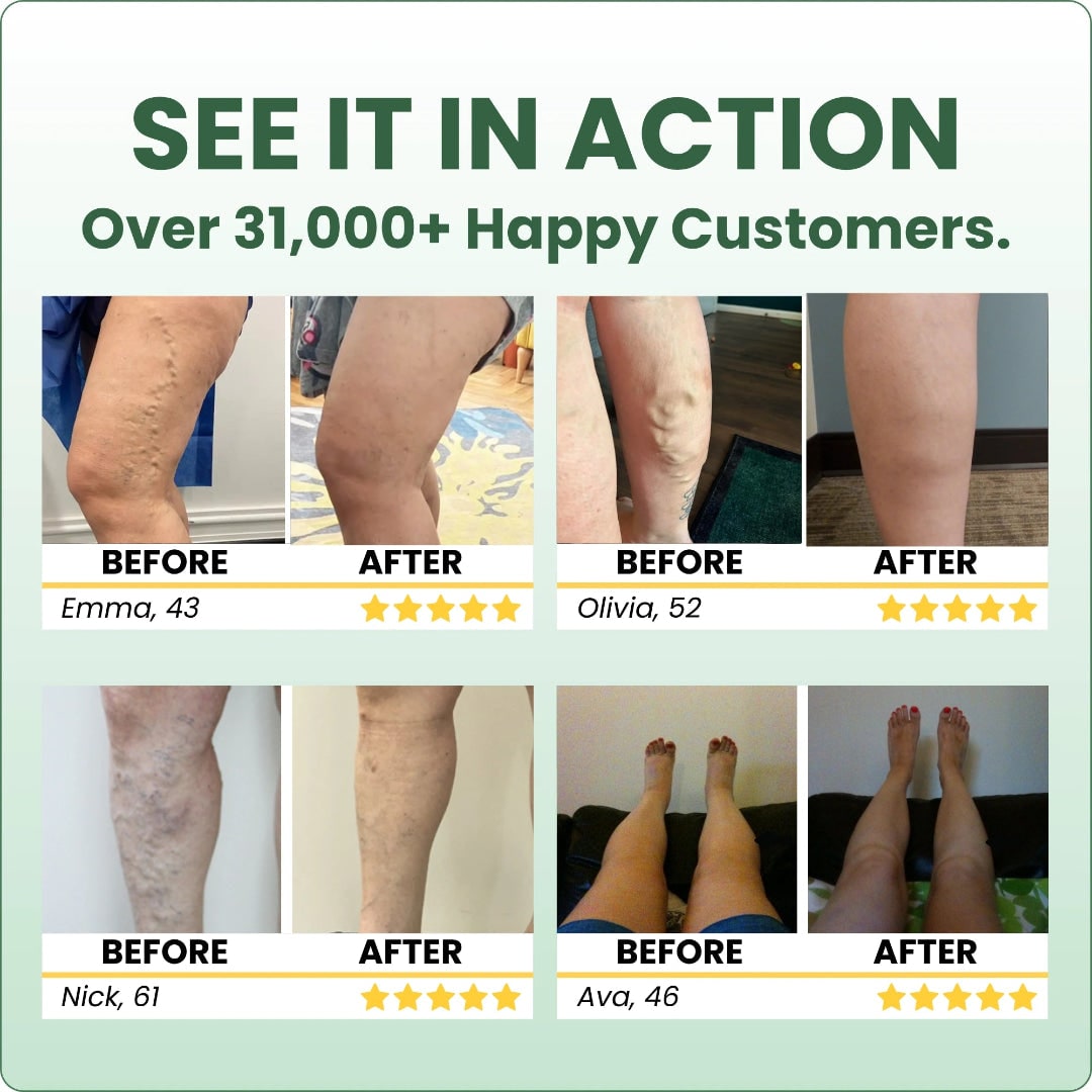 Leg Swelling Cream with Horse Chestnut and Arnica Varicose Vein Balm - Image 13