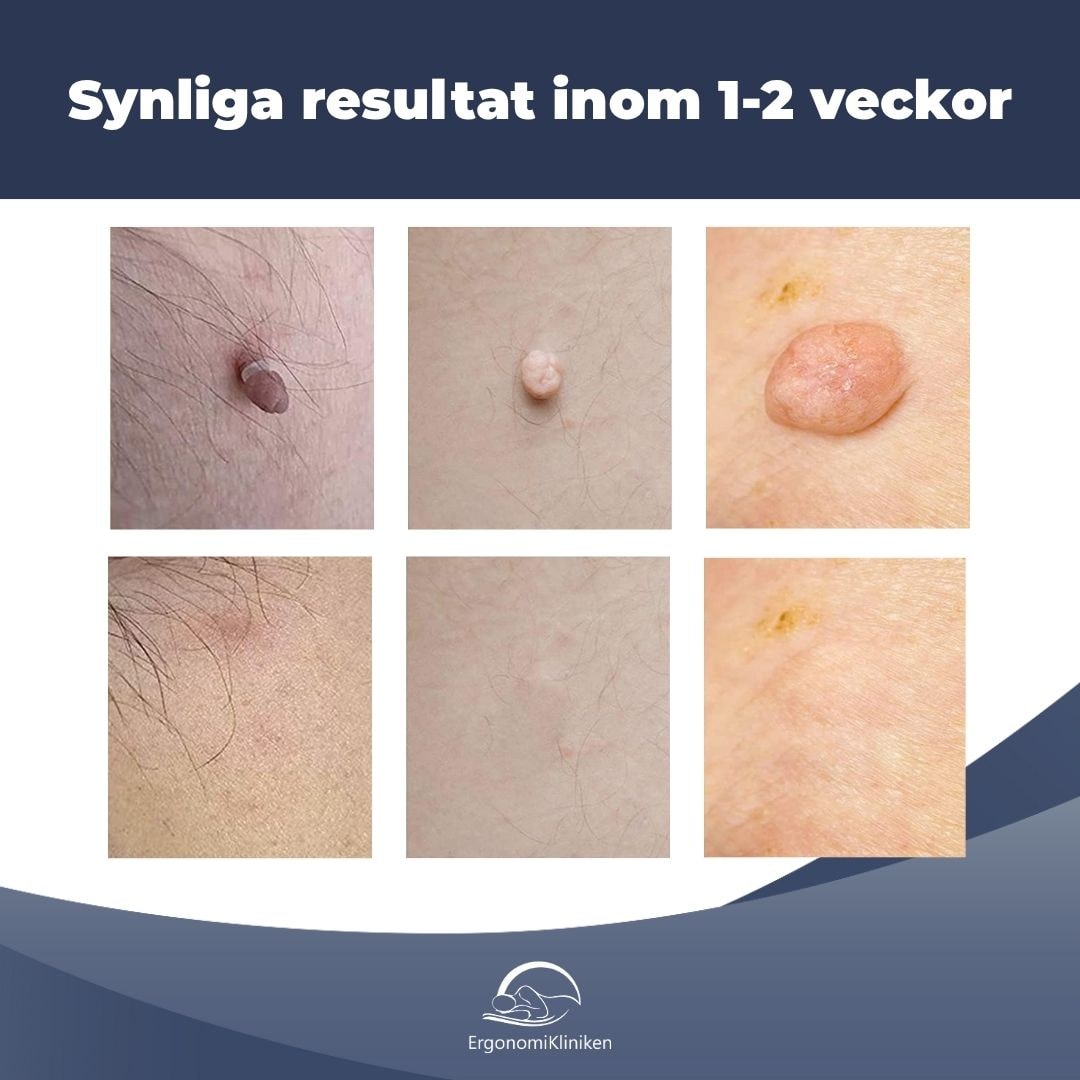 Skin Tag Removal Kit with Band Applicator for Armpit Eyelid and Under at Home - Image 2