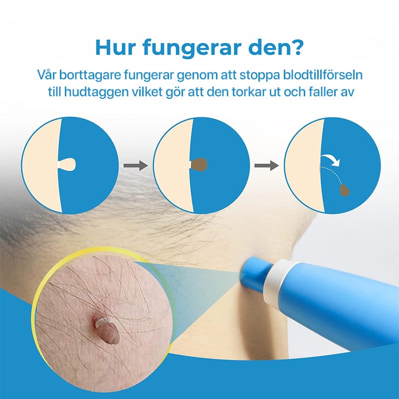 Skin Tag Removal Kit with Band Applicator for Armpit Eyelid and Under at Home - Image 4