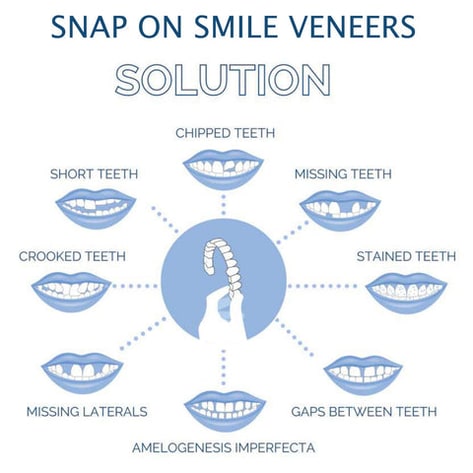 Snap on Veneers Cosmetic Dental Temporary Flexible Plastic Upper Lower - Image 6
