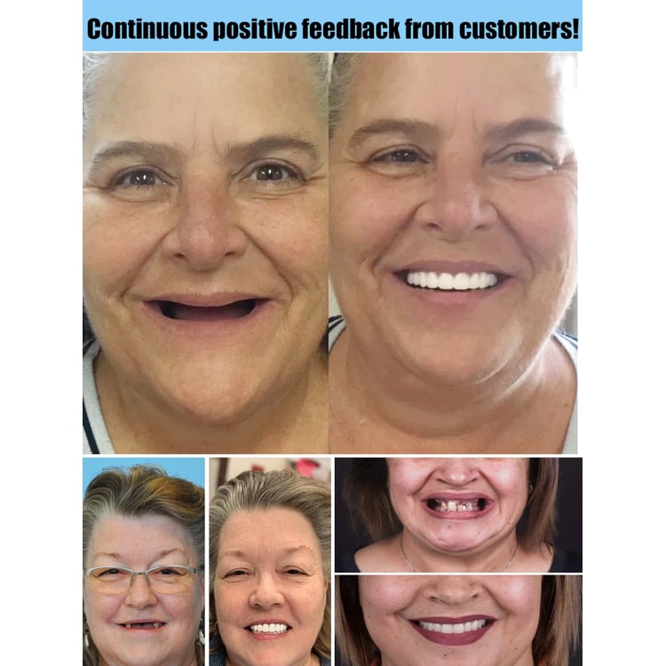 Snap on Veneers Upper and Lower Teeth with Moldable Cosmetic Fake for Temporary Wear - Image 5